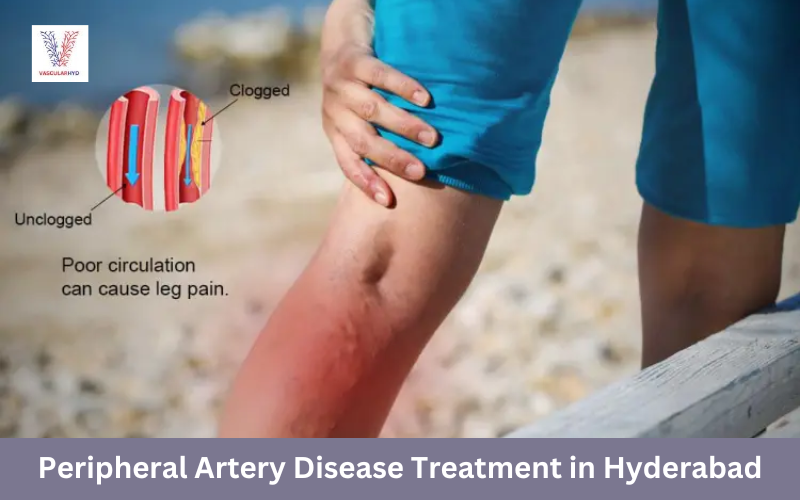 Peripheral Artery Disease Treatment in Hyderabad: Dr. Rahul Agarwal's Expertise at VascularHyd